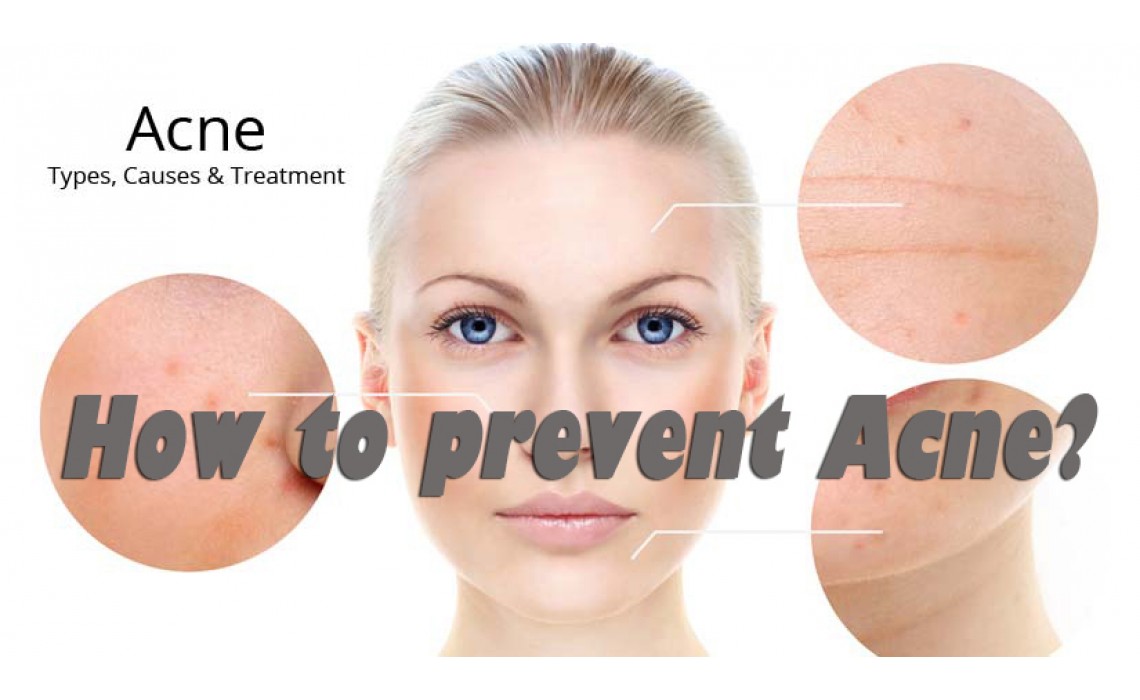 How to prevent Acne? How to prevent Acne?