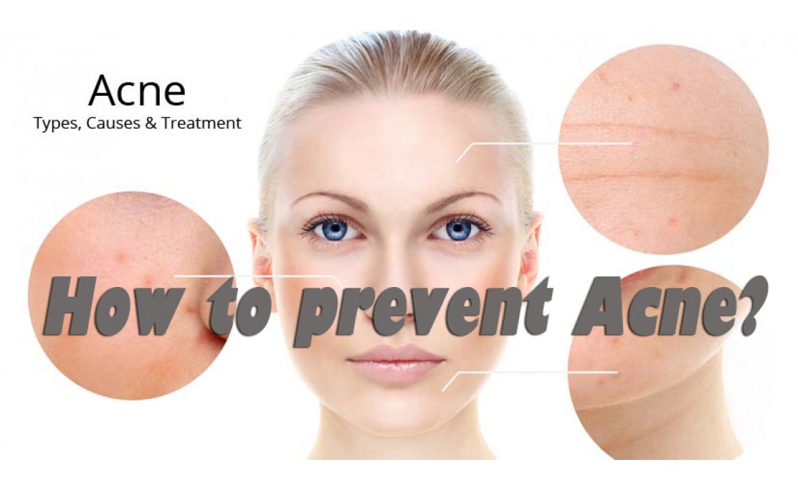 How to prevent Acne?