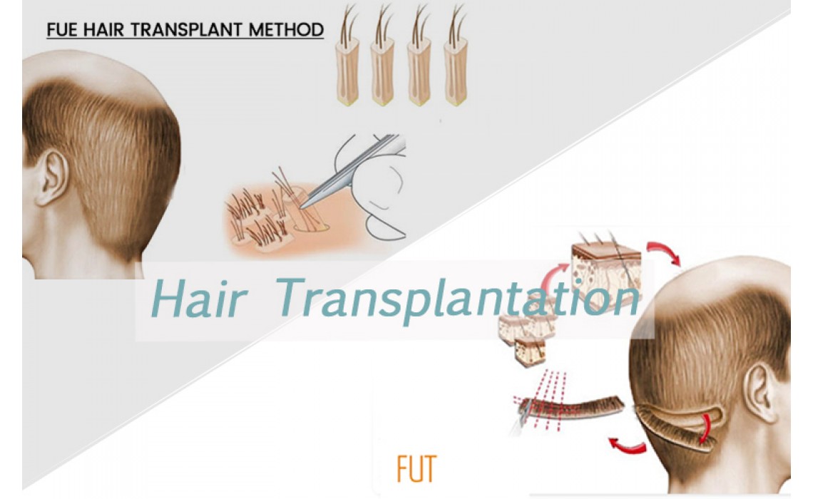 What’s the difference between FUT with FUE about hair transplant?